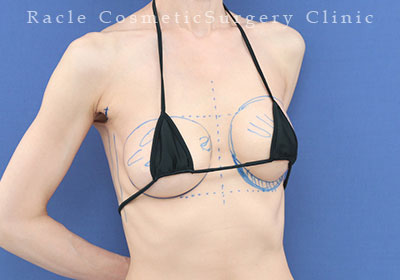 手術前デザイン