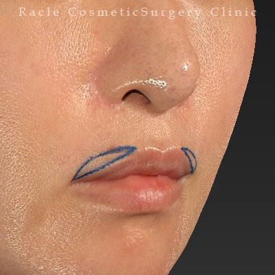 手術前デザイン