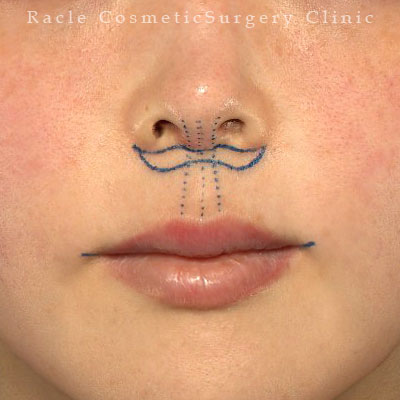 手術前デザイン