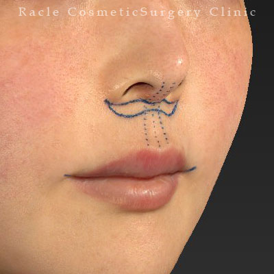 手術前デザイン