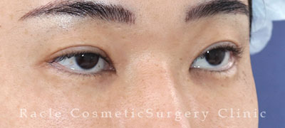 手術後12ヶ月目