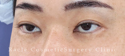 手術後12ヶ月目