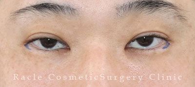 手術前デザイン