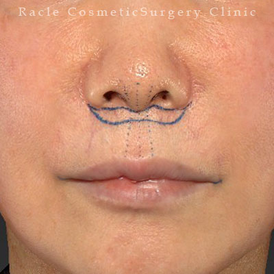 手術前デザイン