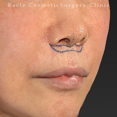 手術前デザイン