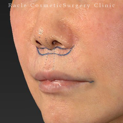 手術前デザイン