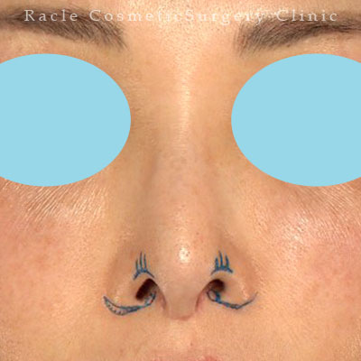 手術前デザイン