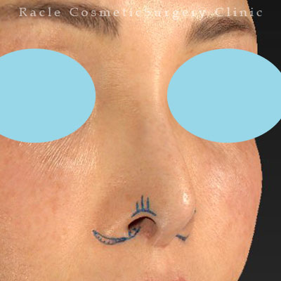 手術前デザイン