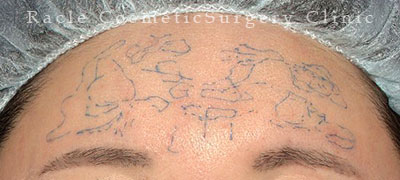 注入前デザイン