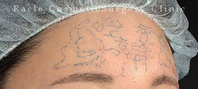 注入前デザイン