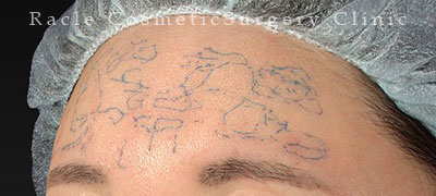 注入前デザイン