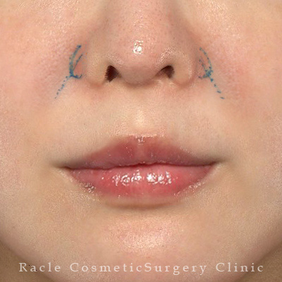 手術前デザイン