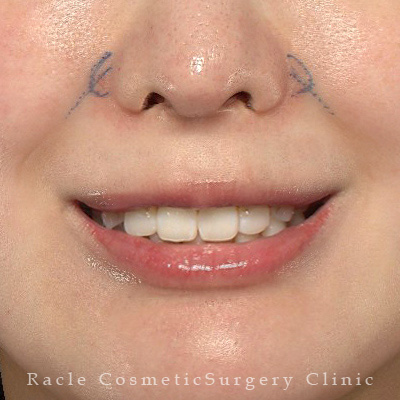 手術前デザイン