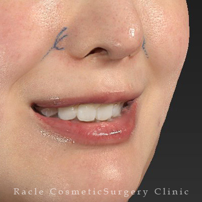 手術前デザイン