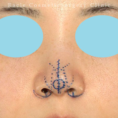 手術前デザイン