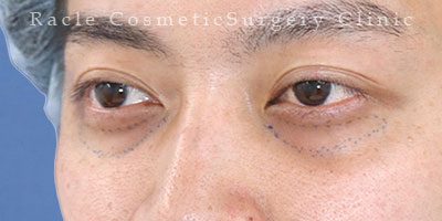 手術前デザイン