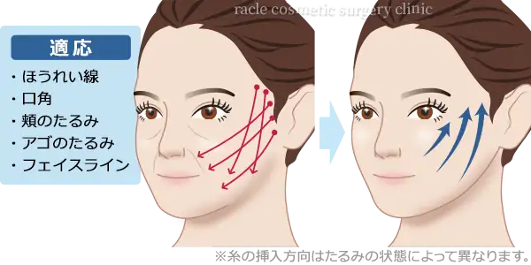 アルテミスリフト 適応イメージ