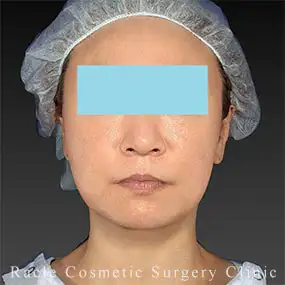 アルテミスリフトの症例写真01 After