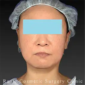 アルテミスリフトの症例写真01 Before