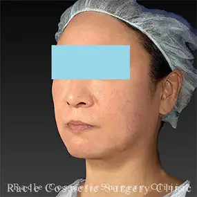 アルテミスリフトの症例写真02 Before