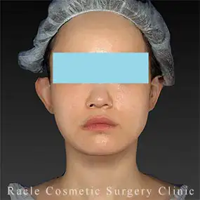 アルテミスリフトの症例写真03 Before