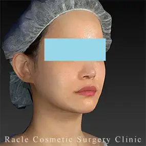 アルテミスリフトの症例写真04 After