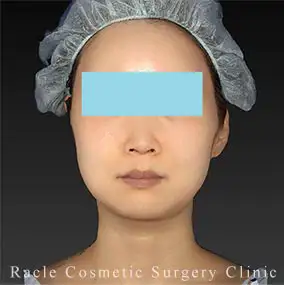 アルテミスリフトの症例写真05 Before