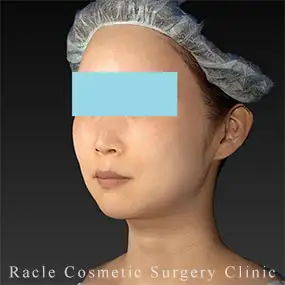 アルテミスリフトの症例写真06 After