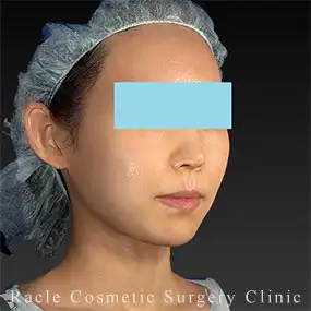 アルテミスリフトの症例写真07 After