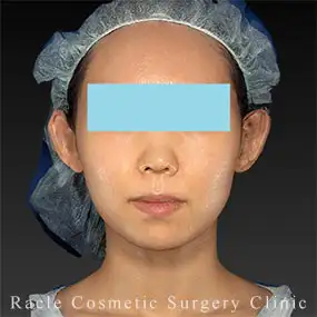 アルテミスリフトの症例写真08 After