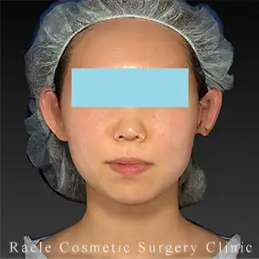 アルテミスリフトの症例写真08 Before