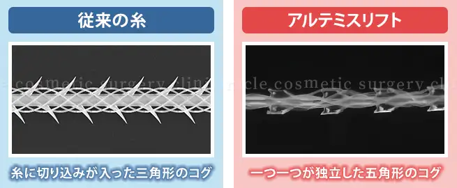 従来の糸とアルテミスリフトの比較イメージ