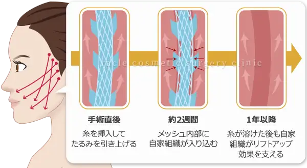 アルテミスリフト 引き上げ効果の持続メカニズム イメージ