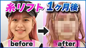 糸リフト Youtube動画05　サムネイル