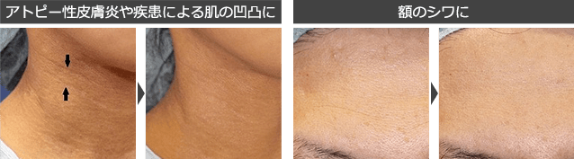 ベビーコラーゲン　アトピー疾患による肌の凸凹・額のシワ　イメージ