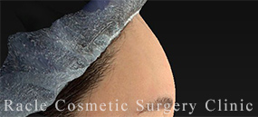 エランセの症例写真03 After