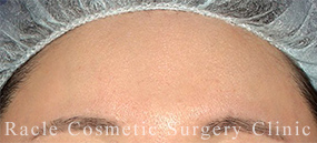 エランセの症例写真04 Before