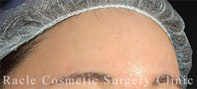 エランセの症例写真05 After