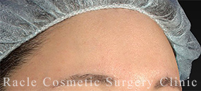 エランセの症例写真05 Before