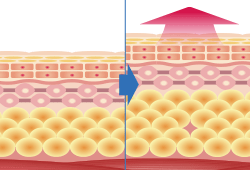 脂肪注入　イメージ