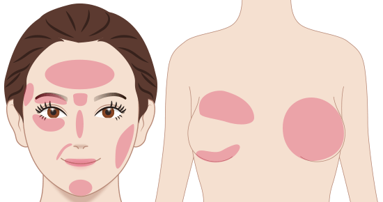 ヒアルロン酸を溶かしたい部位例のイメージイラスト