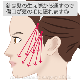 針は髪の生え際から通すので傷口が髪の毛に隠れる　イメージ