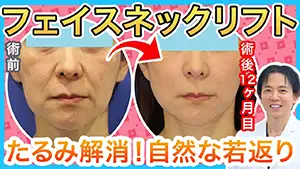 フェイスリフト Youtube動画01　サムネイル