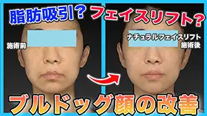 フェイスリフト Youtube動画04　サムネイル
