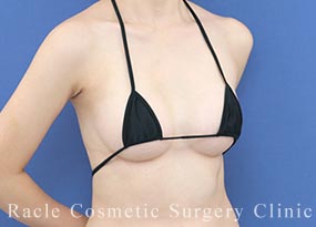 ハイブリッド豊胸の症例写真01 After