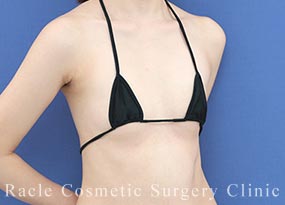 ハイブリッド豊胸の症例写真01 Before