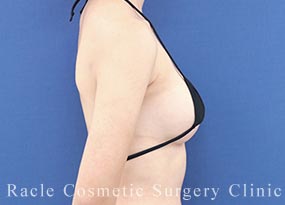 ハイブリッド豊胸の症例写真02 After