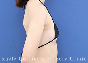 ハイブリッド豊胸の症例写真02 Before