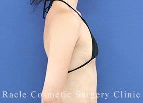 ハイブリッド豊胸の症例写真02 Before