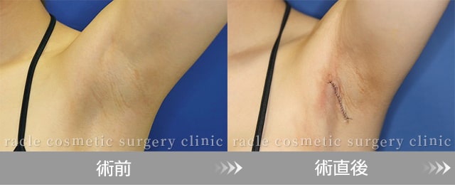 モティバ)エルゴノミクス(腋窩切開法)　傷の経過 術前、術直後写真